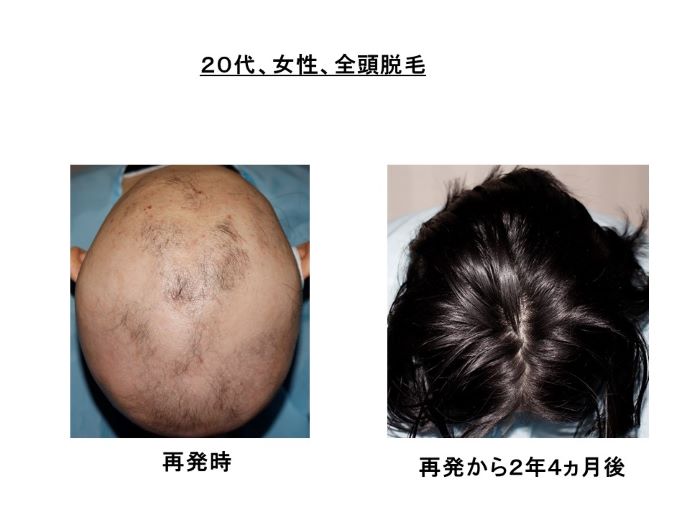 円形脱毛症　病院